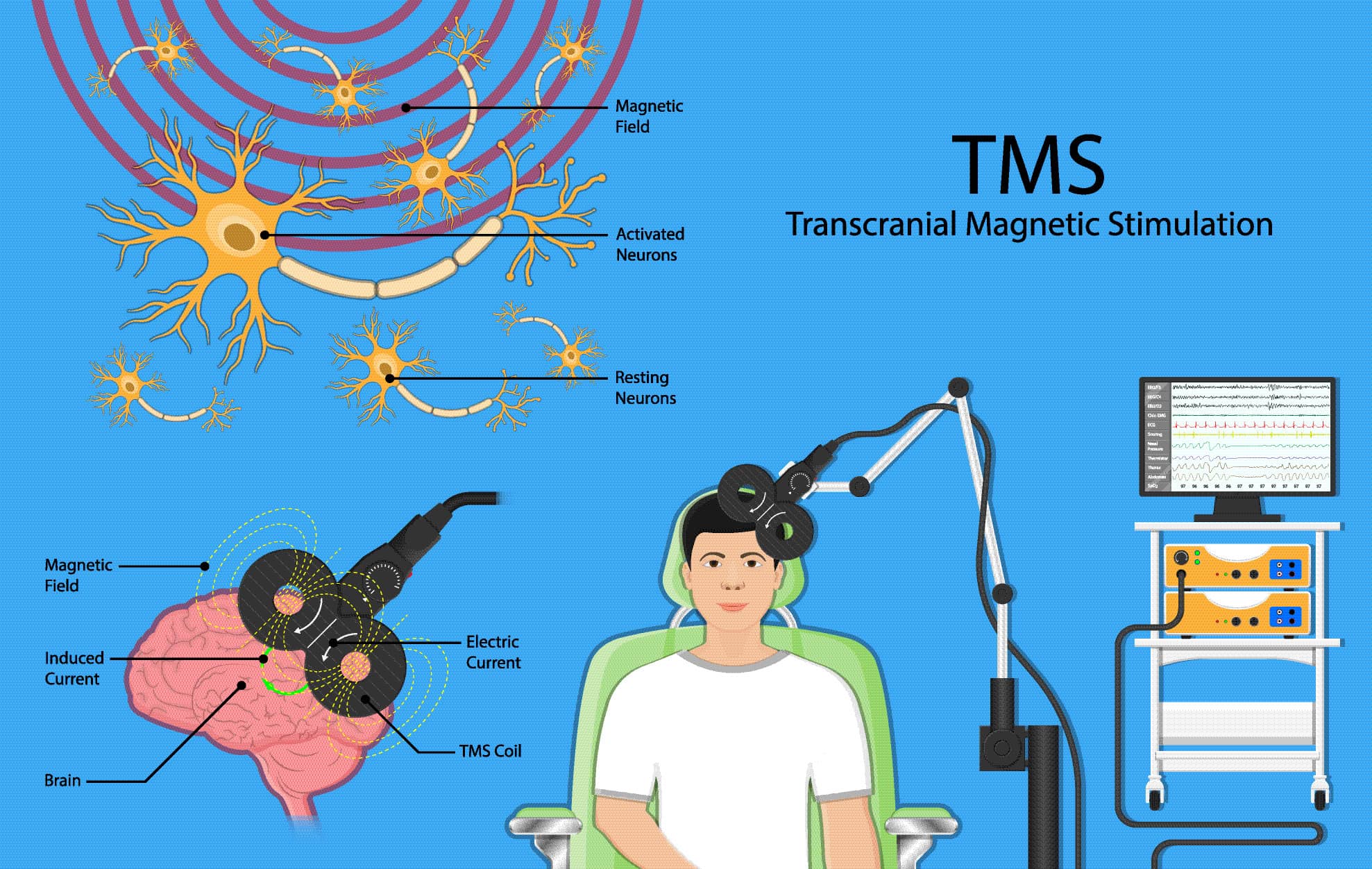 Transcranial magnetic stimulation